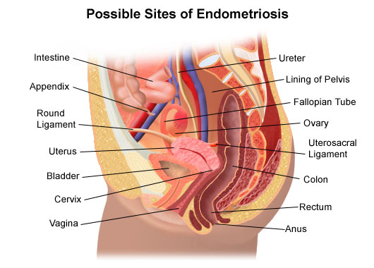 traditional Chinese Medicine in endometriosis